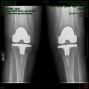 Mom’s New Knees – The Sequel: Help Us Write the Next Chapter of Her Journey